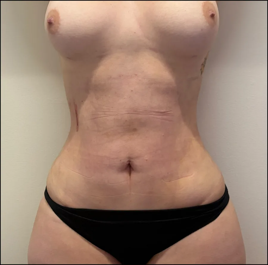 Abdomen de una paciente tras el tratamiento, vista frontal.